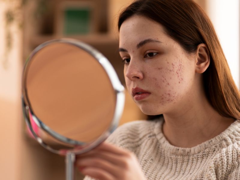 Acne Treatment